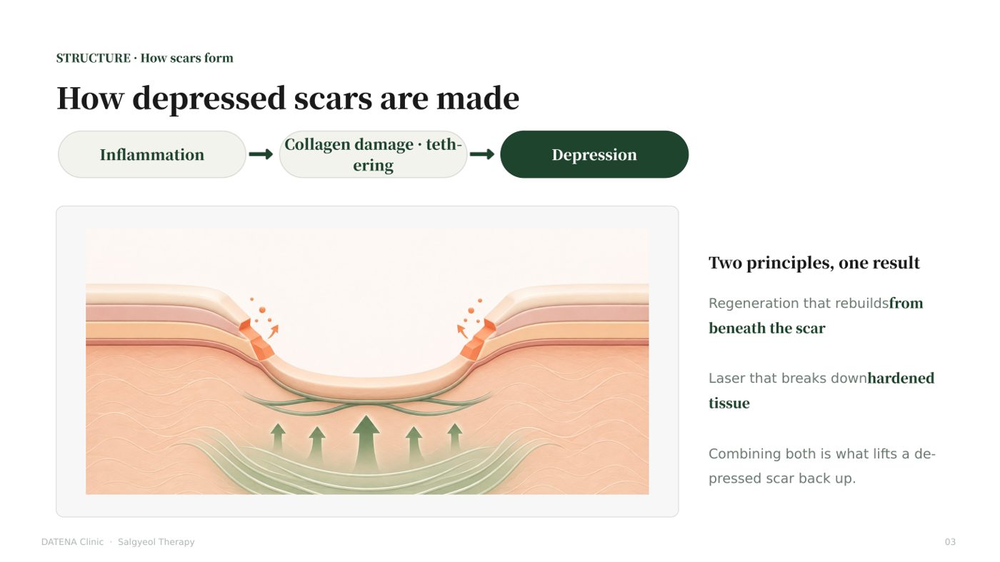 How depressed scars are made — inflammation, collagen damage and tethering, depression